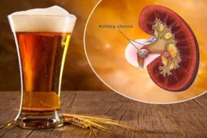 Beer on Kidney Stones 1687488592